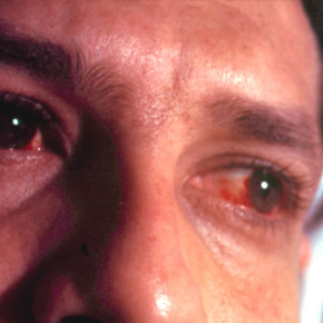 Воспалительные заболевания глаз часто провоцируют обычные простуды