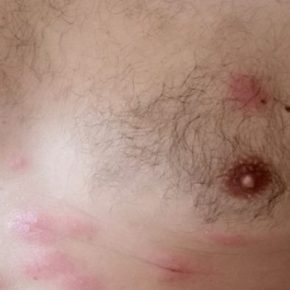 Cумная история с укрытиями в Тернополе: мужчину, который помогал убирать подвал дома, покусали блохи