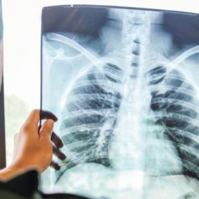 В Тернопольской области за два месяца выявили 50 больных туберкулезом