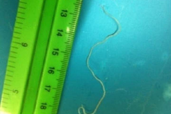 Львовские медики вытащили из глаза трехлетней девочки 10-сантиметрового паразита