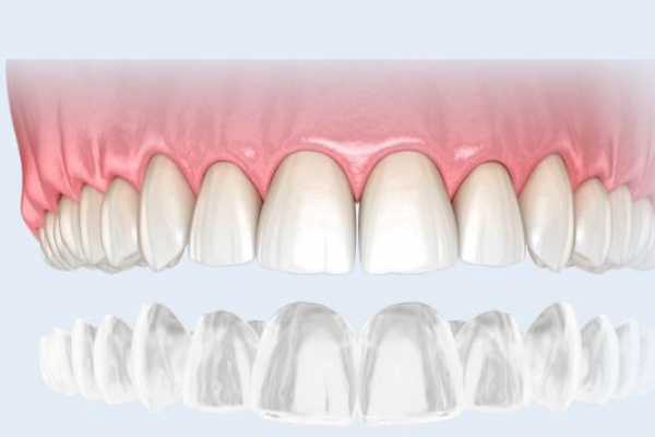 Выравнивание зубов элайнерами: почему следует выбрать данный способ